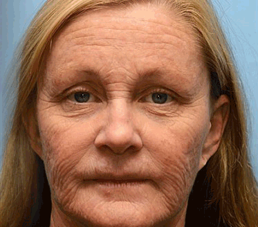 𝑶𝒇𝒇𝒊𝒄𝒊𝒂𝒍 𝑺𝒕𝒐𝒓𝒆👍| Erhalten Sie jetzt jugendliche Haut zurück 💫STDEI® BOTOX & VITA A RETINOL SHOT Faltenstraffende Creme