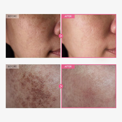 Arbutin 7 % + Tranexamsäure 4 % Creme